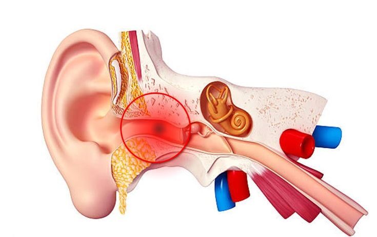 what are middle ear infections