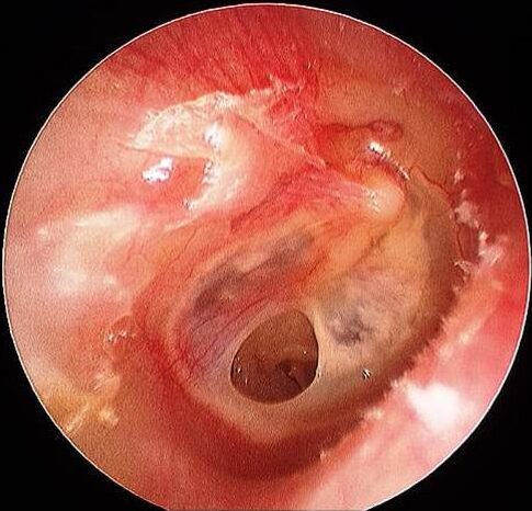ear perforated small